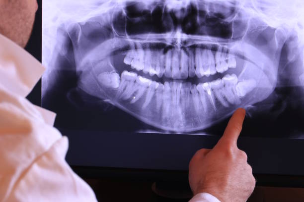 Best Knocked-Out Tooth (Avulsed Tooth) Treatment in Pantops, VA